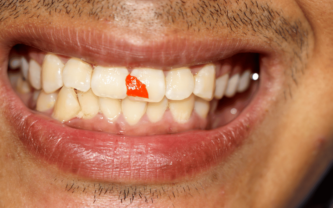 Food Stuck in Your Gums or Teeth? Here’s What to Do
