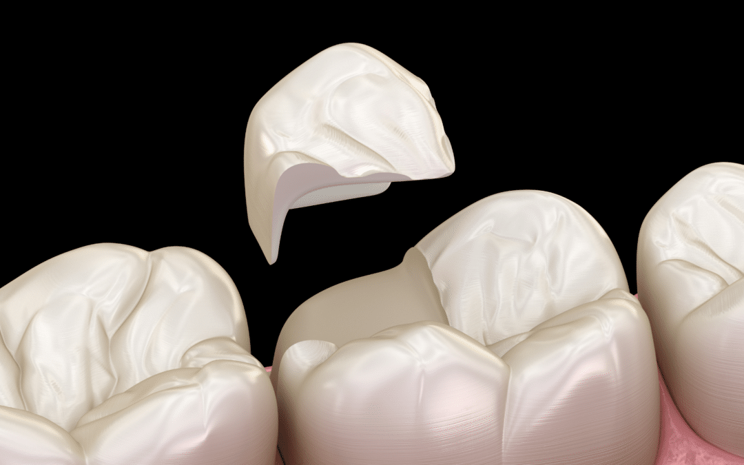 How to Identify and Repair a Chipped Tooth