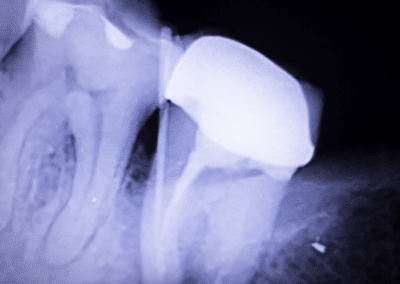 Explaining the Tooth Abscess Stages and How You Can Find Relief