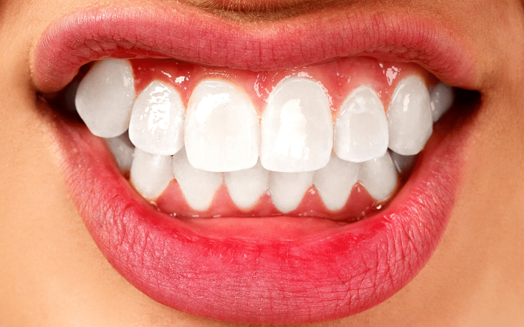 What’s a Crossbite? Explaining Causes, Symptoms, & Treatments