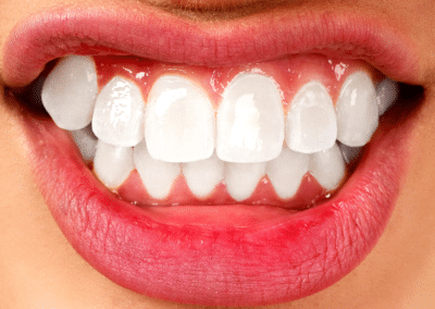 What’s a Crossbite? Explaining Causes, Symptoms, & Treatments