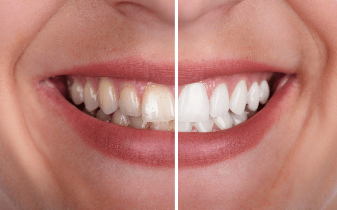 What Happens If You Never Floss?