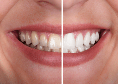 What Happens If You Never Floss?